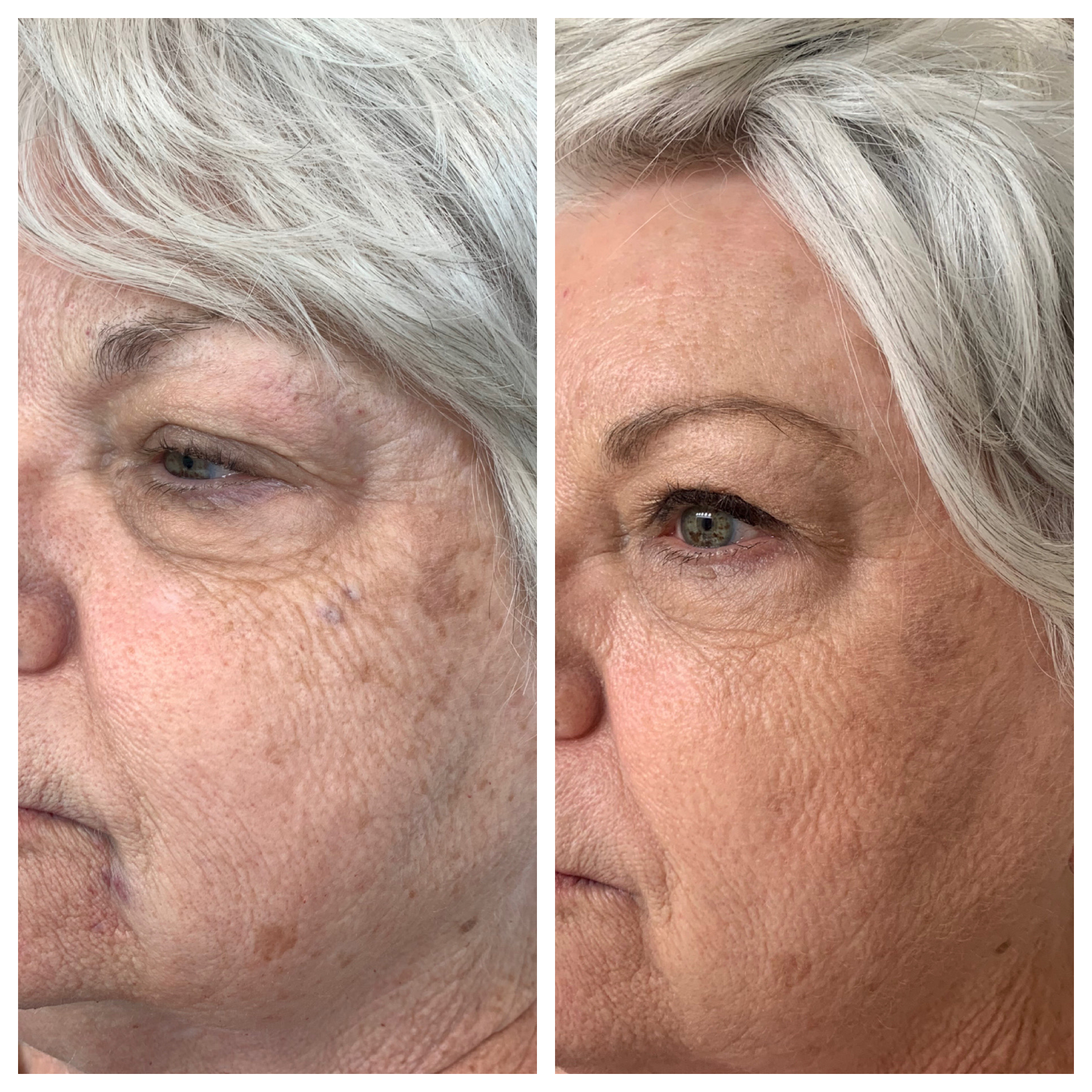 Botox & Dysport Before and After Photo by Kim Engelhardt, MSN, APRN, ANP-BC in Brentwood, Tennessee
