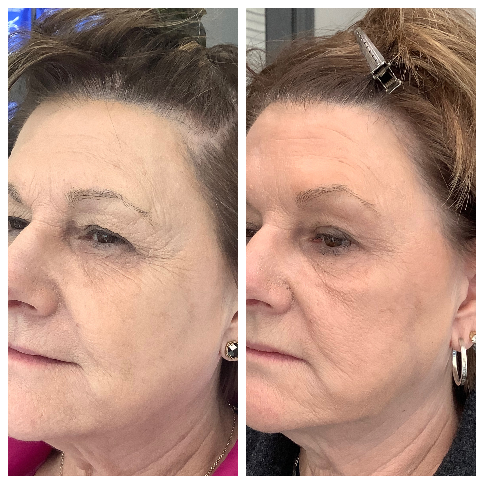 Botox & Dysport Before and After Photo by Kim Engelhardt, MSN, APRN, ANP-BC in Brentwood, Tennessee