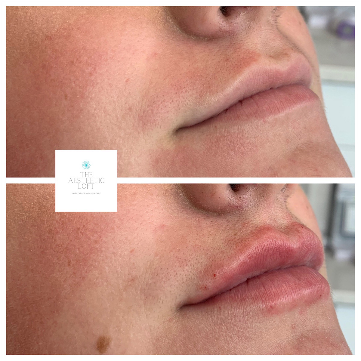 Lip Filler Before and After Photo by Kim Engelhardt, MSN, APRN, ANP-BC in Brentwood, Tennessee