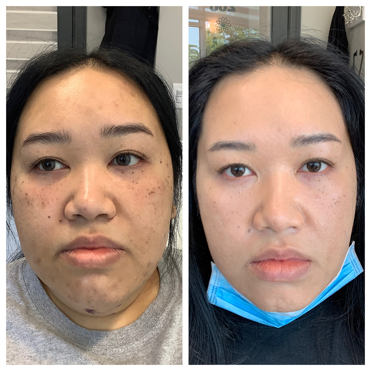ZO 3 Step Before and After Photo by Kim Engelhardt, MSN, APRN, ANP-BC in Brentwood, Tennessee