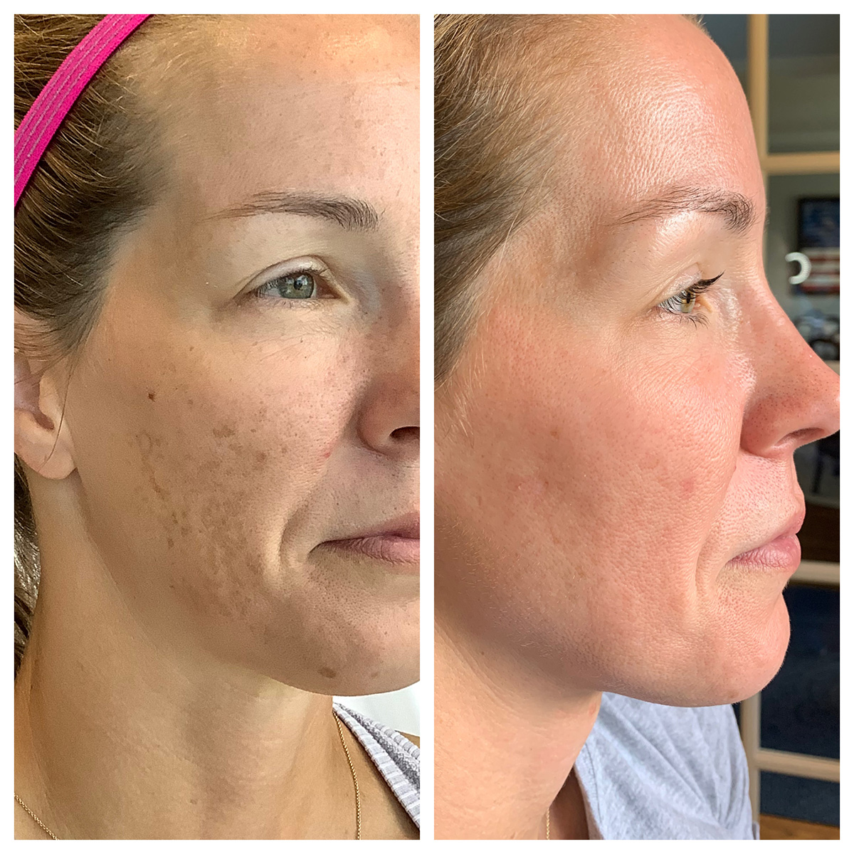 ZO Pigmet Program Before and After Photo by Kim Engelhardt, MSN, APRN, ANP-BC in Brentwood, Tennessee