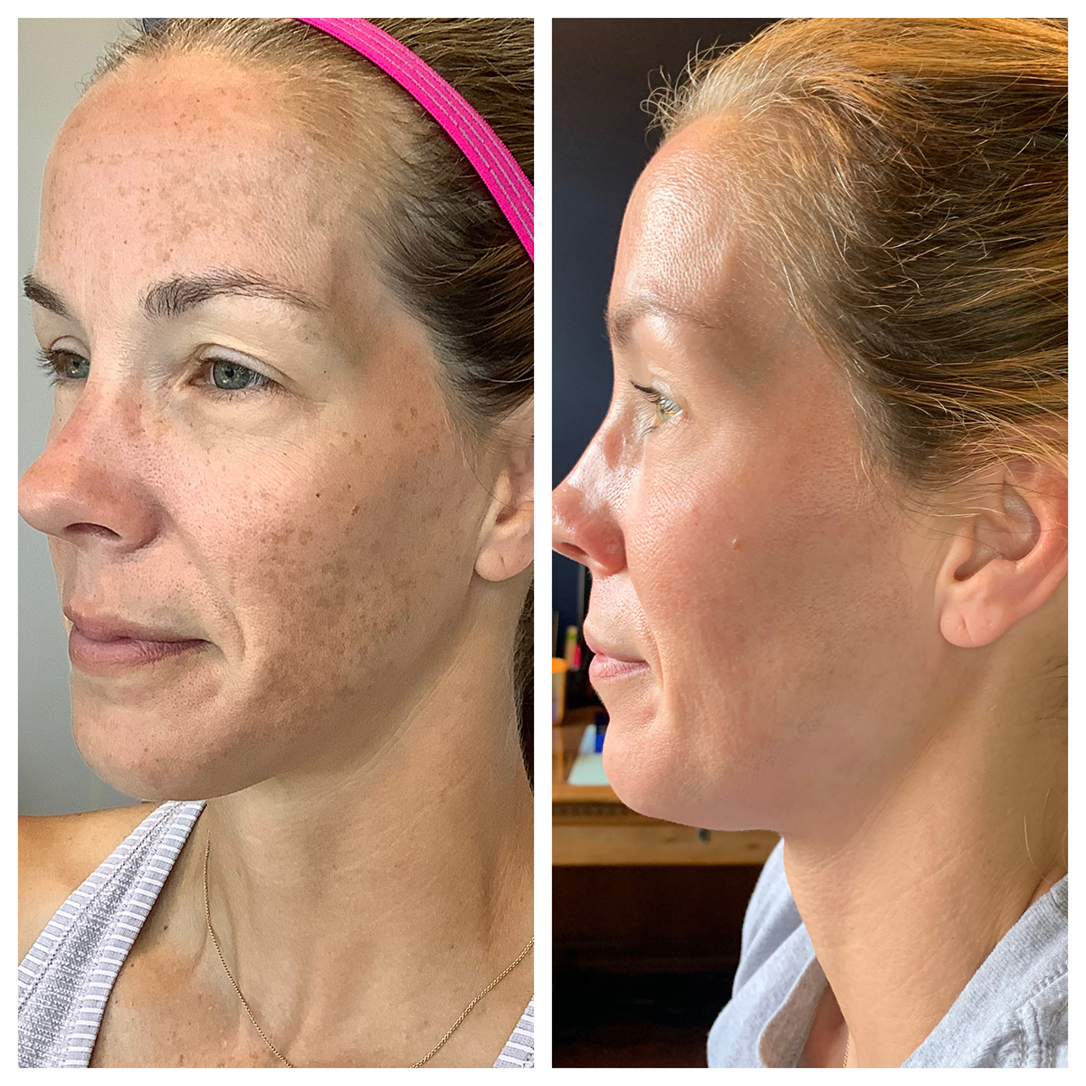ZO Pigmet Program Before and After Photo by Kim Engelhardt, MSN, APRN, ANP-BC in Brentwood, Tennessee