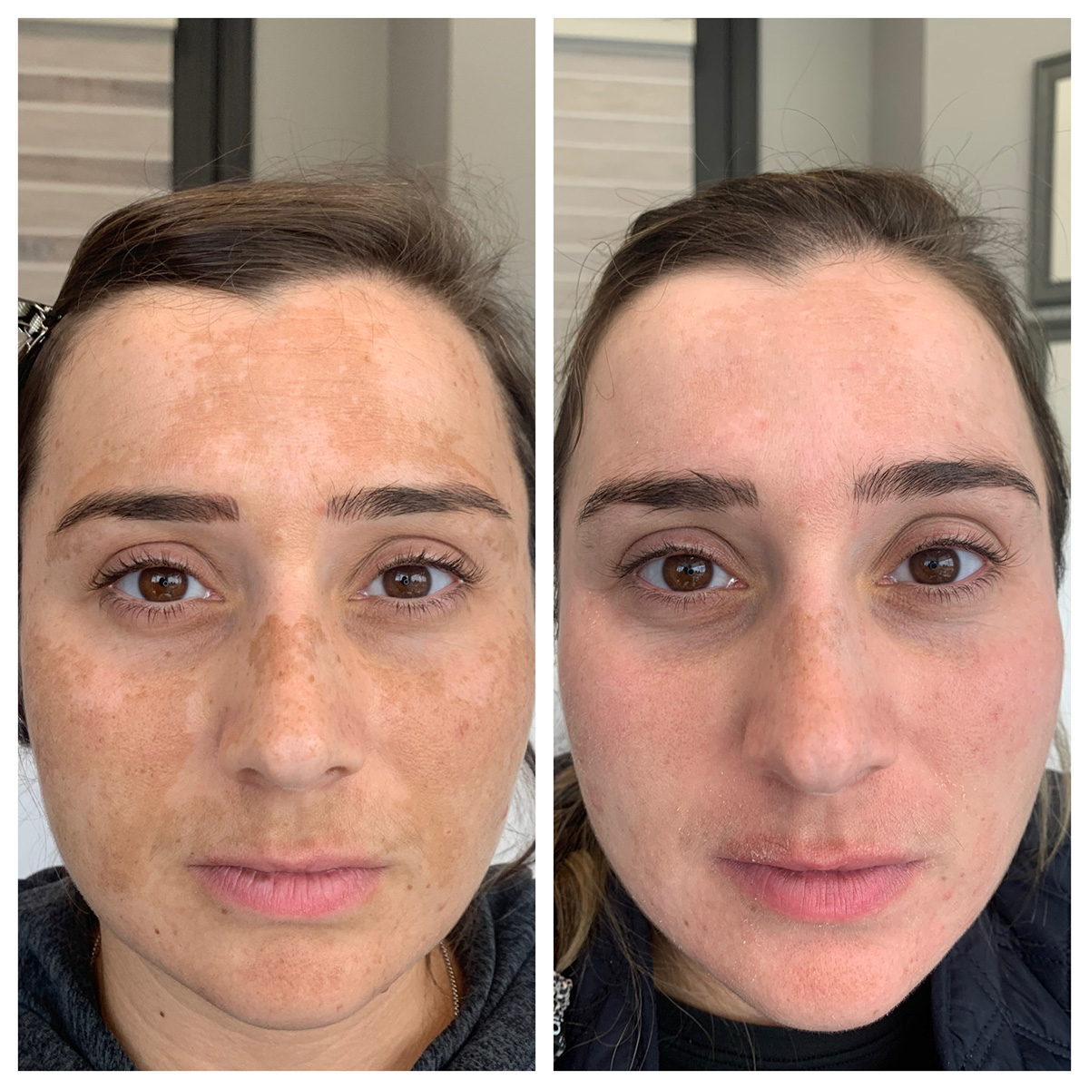 ZO Pigment Program Before and After Photo by Kim Engelhardt, MSN, APRN, ANP-BC in Brentwood, Tennessee