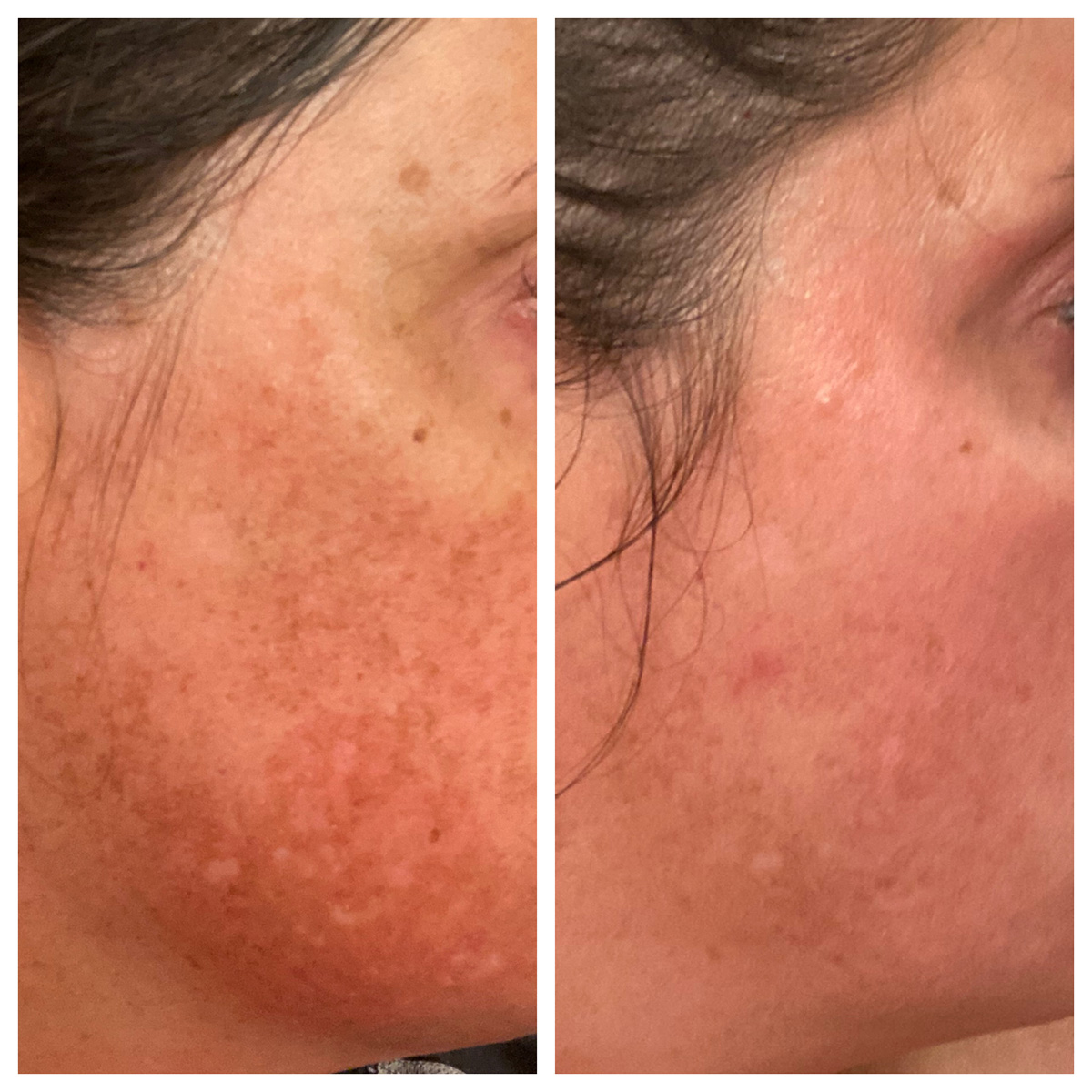 ZO Pigment Program Before and After Photo by Kim Engelhardt, MSN, APRN, ANP-BC in Brentwood, Tennessee