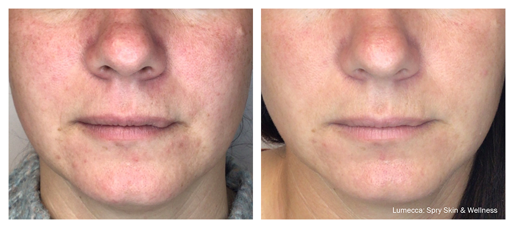 Lumecca Before and After Photo courtesy of Spry Skin and Wellness in Brentwood, Tennessee