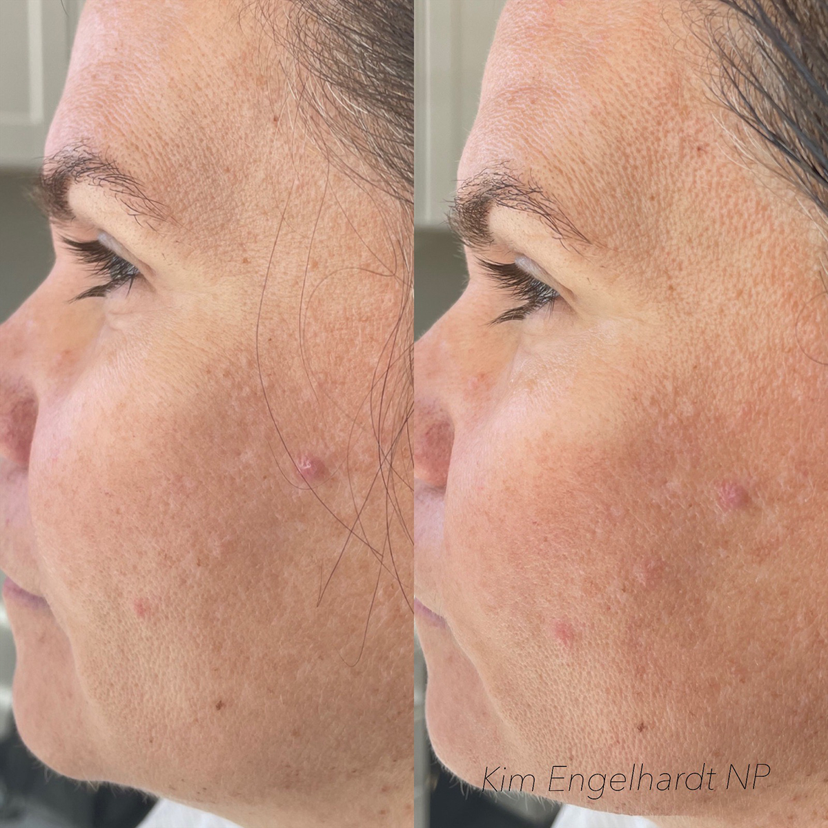 Diamond Glow Before and After Photo by Kim Engelhardt, MSN, APRN, ANP-BC in Brentwood, Tennessee